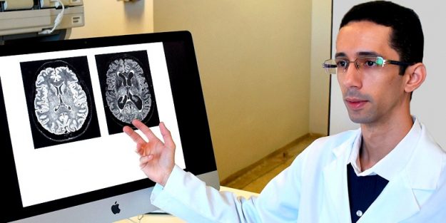 cerebro e saude - relacao avc demencia fibrilacao arterial - unicamp